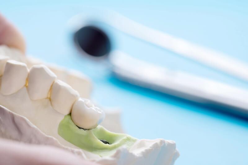 Dental Implants Dental Implants